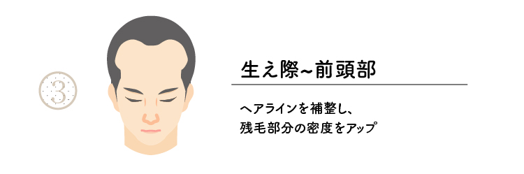 範囲3生え際から前頭部