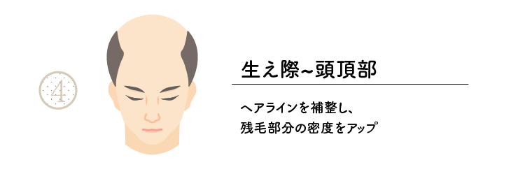 範囲4生え際から頭頂部