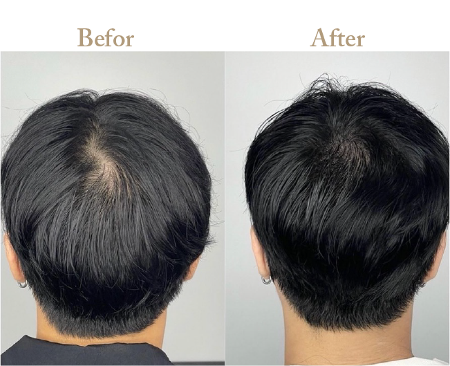 ヘアアートメイク治療Befor_Afterその1