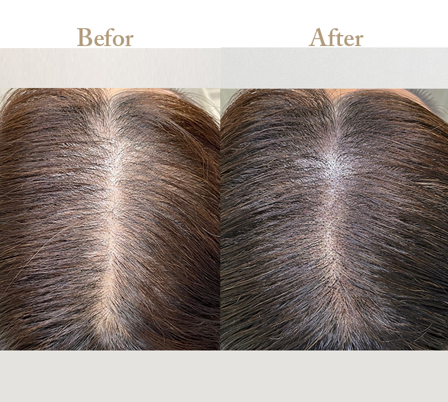 ニキビの治療Befor_Afterその3