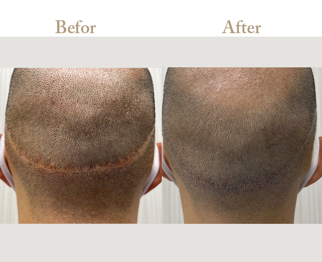 ニキビの治療Befor_Afterその4