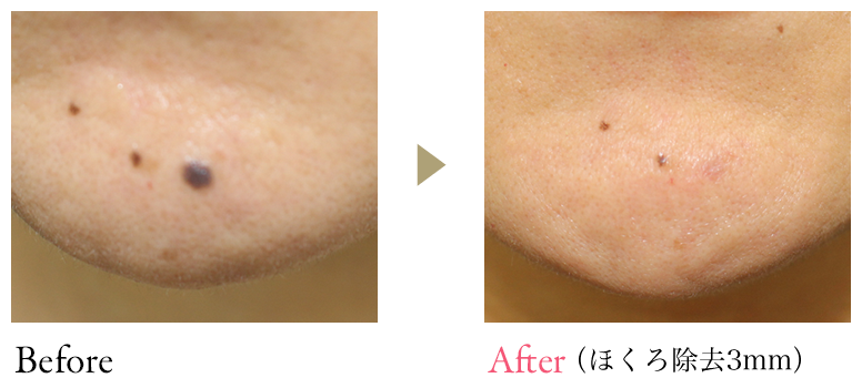 Before After(ほくろ除去3mm)