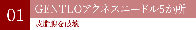 GENTLOアクネスニードル5か所