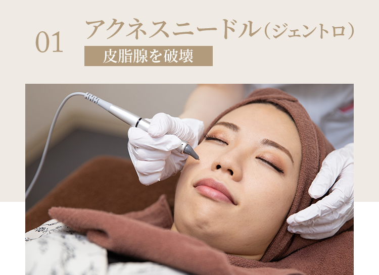 アクネスニードル（ジェントロ）施術の様子