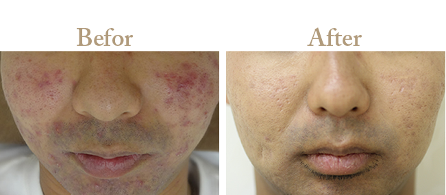 ニキビの治療Befor_Afterその1