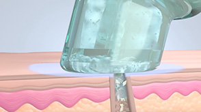 毛穴ケア＋保湿のイメージ画像