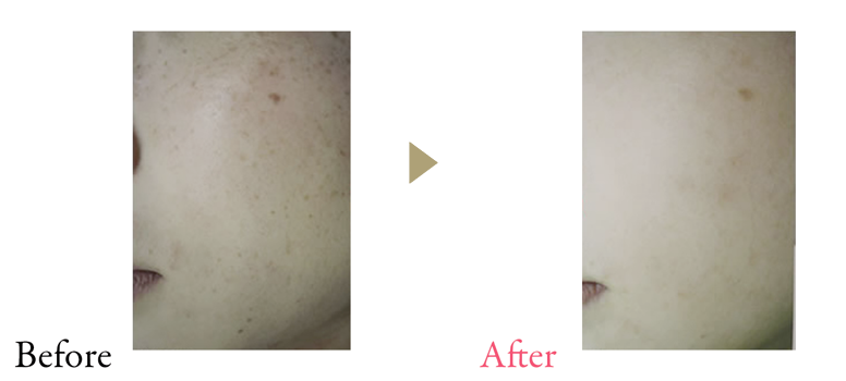 Before After (術直後 60本施術)